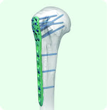 Proximal Humeral Locking Plate Ⅱ - xpmed