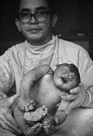 Philip Jones Griffiths in Memorium. HANOI, VIETNAM - The son of Mrs. Le Hu Thin preserved at the Viet Duc Hospital. Her husband, Nguyen Van Oanh, ... - 22