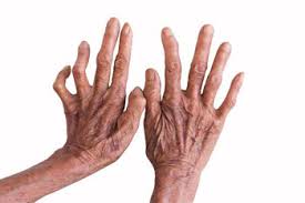 Image result for kusta tidak menjijikkan