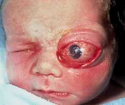 Image result for teratoma