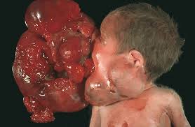 Image result for teratoma