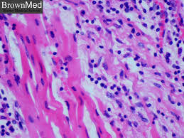 Kết quả hình ảnh cho myocarditis