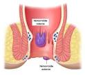 Hemorroide interne symptome