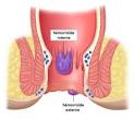 Hemorroide interne