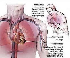 Gejala Penyakit Paru-Paru Lembap (Pneumonia)