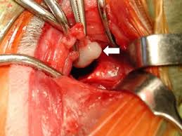 Image result for inner ear surgery