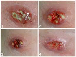 Image result for mrsa