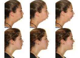 Image result for jaw surgery