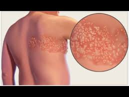 Image result for "Herpes Zoster"