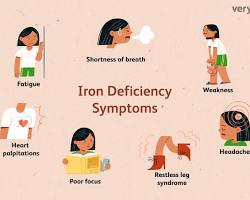 Image of Iron deficiency anemia