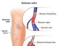 Image of varicose veins