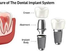 Dental implant abutment placement