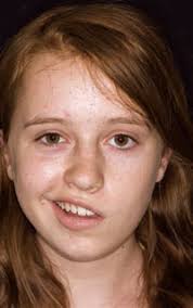 Image result for bells palsy