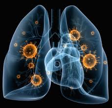 Hasil gambar untuk pneumonia