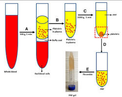 صورة Plateletrich plasma (PRP) preparation