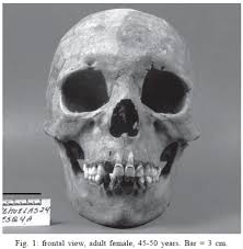 Résultat de recherche d'images pour "shovel shaped incisors"