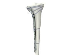 MISS Proximal Tibia Lateral Plates – TST