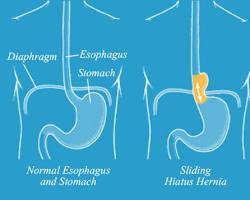 Paraesophageal hiatal hernia in the body