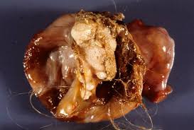 Image result for teratoma