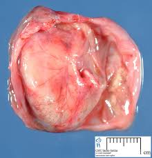Image result for teratoma