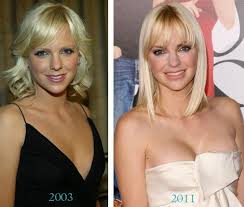 Resultado de imagem para before after surgery