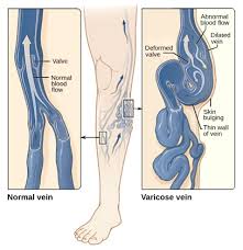 Picture of varicose veins
