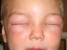 Allergie gonflement visage