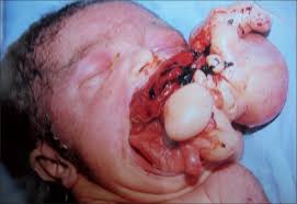 Image result for teratoma