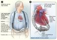 End stage heart failure