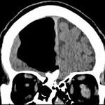  Doctors find air pocket where part of man's brain should be