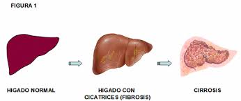 Resultado de imagen para higadoenfermedades