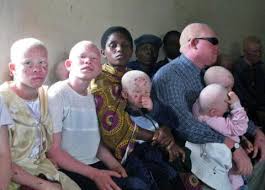 Image result for MALAWI People With Albinism
