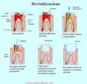 Dente devitalizzato sensibile al caldo