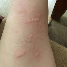 Cơ thể yếu, kh&iacute; huy&ecirc;'t k&eacute;m lưu th&ocirc;ng, m&ecirc;` đay sẽ t&aacute;i ph&aacute;t ...