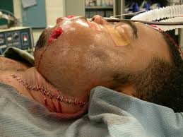 Image result for throat bullet  surgery