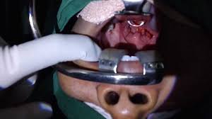 Image result for tonsilith