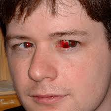 Résultat de recherche d'images pour "eye infection"