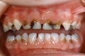 Resultado de imagen de caries y lactancia materna