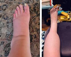 Swollen ankles and feet during pregnancy