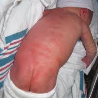 Image result for newborn diaper rash