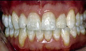 Image result for fluorosis