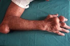 Image result for What is an Acute Gouty Arthritis?