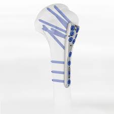 Humerus compression plate - PHF - Intrauma - proximal ...