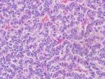 Modern Pathology - Update on small cell carcinoma and its