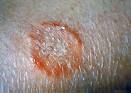 Vad r ringorm? Ringworm Treatment