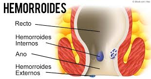 Resultado de imagen de hemorroides