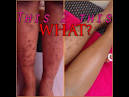 4 Ways to Remove Scars on Legs - How