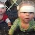 Triplets have surgery for rare skull defect