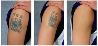 លទ្ធផល​រូបភាព​សម្រាប់ tattoo removal