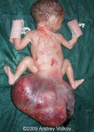 Image result for teratoma